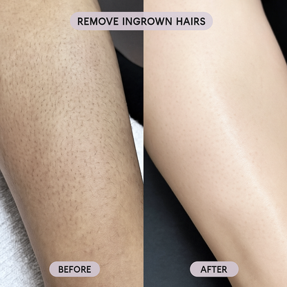 Luméra SkinSense Precision Pulse IPL